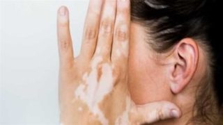 نسبة التحسن 75%.. استشاري أمراض جلدية يكشف تفاصيل علاج البهاق الجديد – جريدة الخبر اليوم