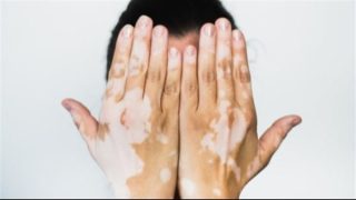 هاني الناظر يكشف حقيقة إيجاد علاج نهائي للبهاق وتكلفته – جريدة الخبر اليوم