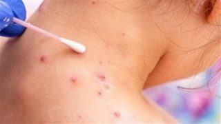 “قد ينتقل عبر الهواء”.. هل تحدث عدوى بفيروس “جدري القرود” عند المصافحة؟ – جريدة الخبر اليوم