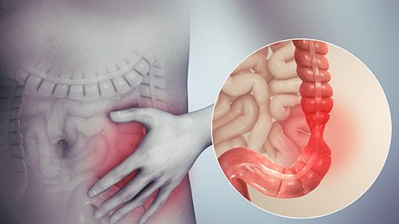 علاج القولون العصبي للتخلص من الأعراض المزعجة