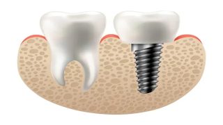 مركز دكتور عمار لطب الاسنان | حلولًا عملية في علاج الاسنان المعوجة بدون تقويم